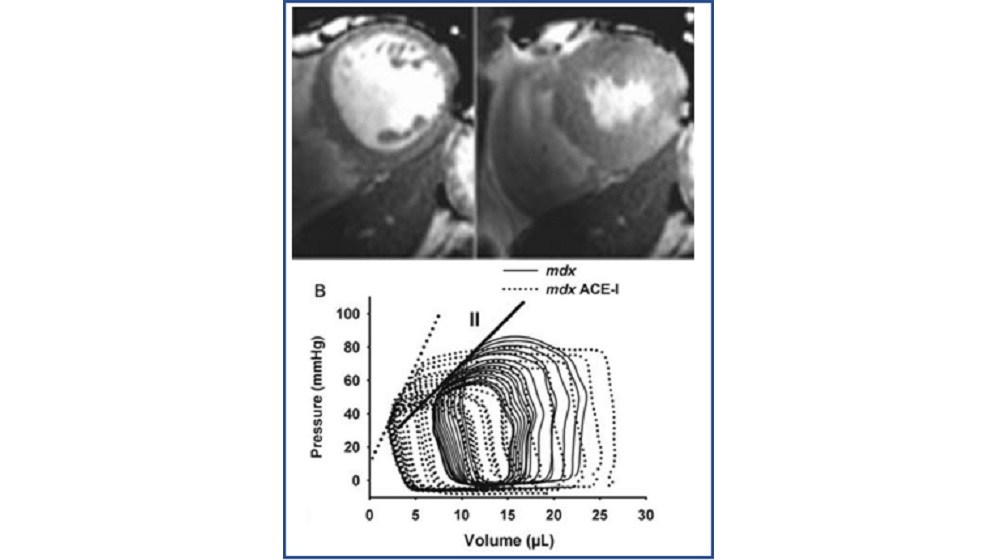 mri-heart-function